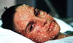 smallpox2.jpg